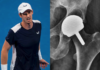 Andy Murray’s Singles Career Might Be Over – Hip Specialist